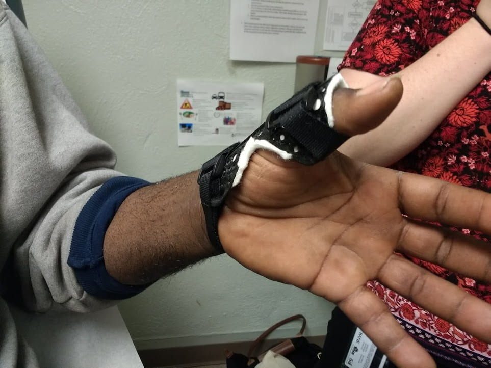 The hand of a blank man stretched out with a black 3D printed splint around his thumb